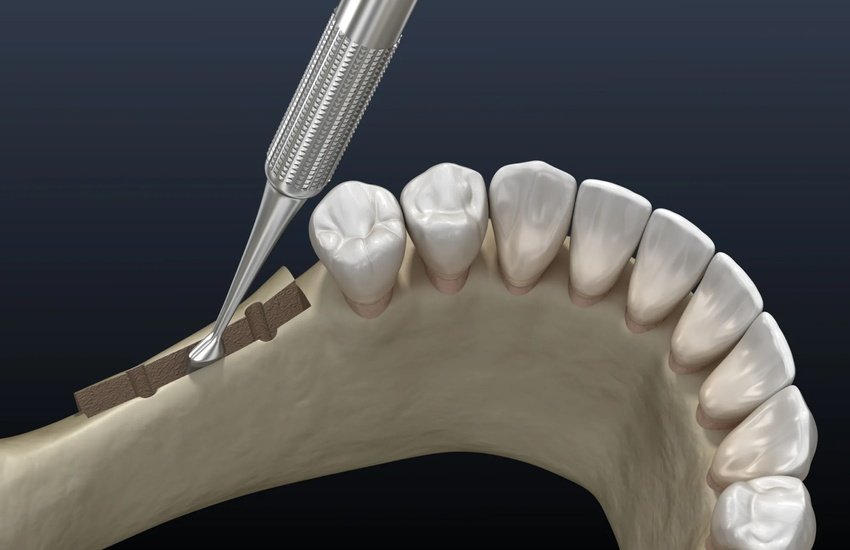 ridge augmentation