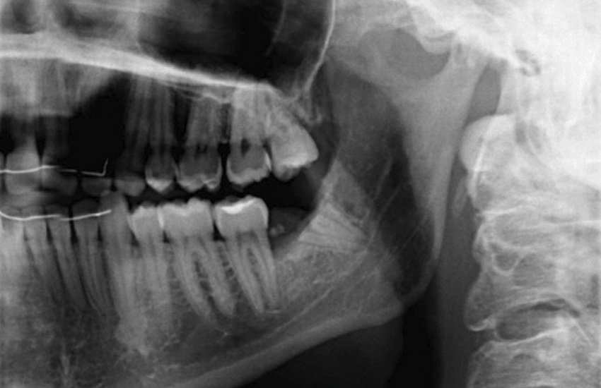 coronectomy